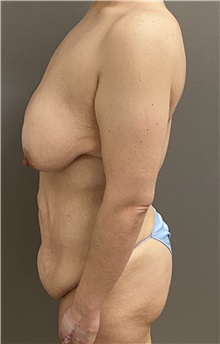 Mommy Makeover Before Photo by Keshav Magge, MD; ,  - Case 50207