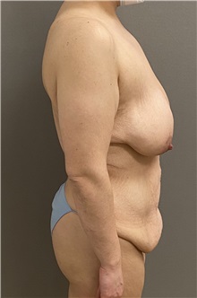 Mommy Makeover Before Photo by Keshav Magge, MD; ,  - Case 50207