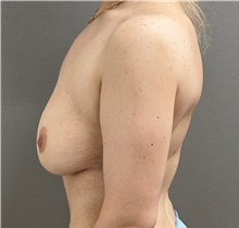 Breast Lift After Photo by Keshav Magge, MD; ,  - Case 50205