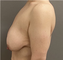 Breast Lift Before Photo by Keshav Magge, MD; ,  - Case 50205