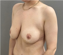 Breast Lift After Photo by Keshav Magge, MD; ,  - Case 50205