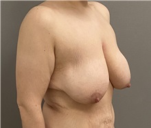 Breast Lift Before Photo by Keshav Magge, MD; ,  - Case 50205