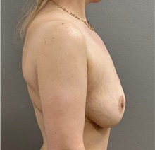 Breast Lift After Photo by Keshav Magge, MD; ,  - Case 50205