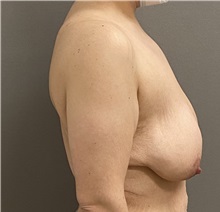 Breast Lift Before Photo by Keshav Magge, MD; ,  - Case 50205