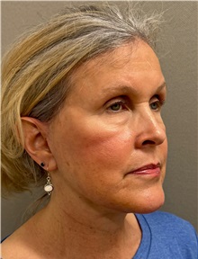 Facelift After Photo by Keshav Magge, MD; ,  - Case 50209