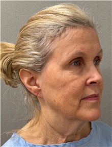 Facelift Before Photo by Keshav Magge, MD; ,  - Case 50209