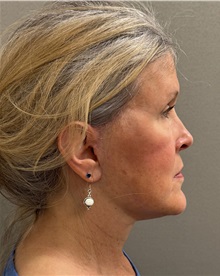 Facelift After Photo by Keshav Magge, MD; ,  - Case 50209