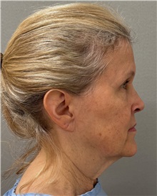 Facelift Before Photo by Keshav Magge, MD; ,  - Case 50209