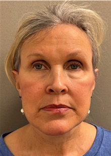 Facelift After Photo by Keshav Magge, MD; ,  - Case 50209