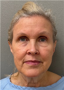Facelift Before Photo by Keshav Magge, MD; ,  - Case 50209