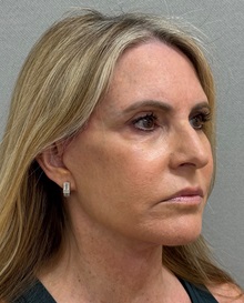 Neck Lift After Photo by Keshav Magge, MD; ,  - Case 50217