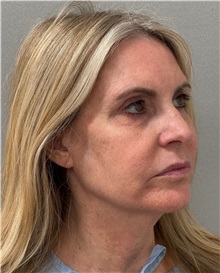 Neck Lift Before Photo by Keshav Magge, MD; ,  - Case 50217