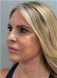 Neck Lift After Photo by Keshav Magge, MD; ,  - Case 50217