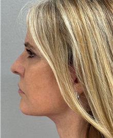 Neck Lift After Photo by Keshav Magge, MD; ,  - Case 50217