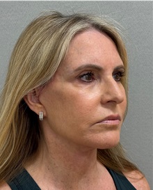 Facelift After Photo by Keshav Magge, MD; ,  - Case 50218