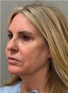 Facelift Before Photo by Keshav Magge, MD; ,  - Case 50218