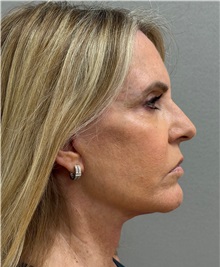 Facelift After Photo by Keshav Magge, MD; ,  - Case 50218