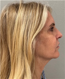 Facelift Before Photo by Keshav Magge, MD; ,  - Case 50218