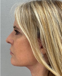 Facelift After Photo by Keshav Magge, MD; ,  - Case 50218
