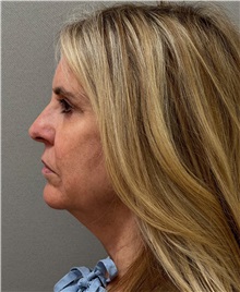 Facelift Before Photo by Keshav Magge, MD; ,  - Case 50218
