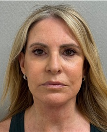 Facelift After Photo by Keshav Magge, MD; ,  - Case 50218