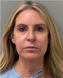 Facelift Before Photo by Keshav Magge, MD; ,  - Case 50218
