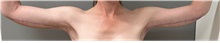 Arm Lift After Photo by Keshav Magge, MD; ,  - Case 50225