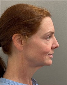 Neck Lift Before Photo by Keshav Magge, MD; ,  - Case 50233
