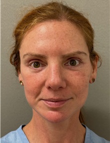 Neck Lift After Photo by Keshav Magge, MD; ,  - Case 50233