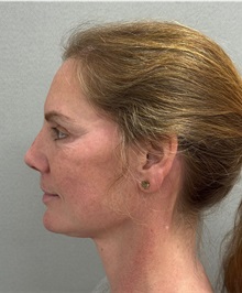 Facelift After Photo by Keshav Magge, MD; ,  - Case 50234