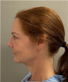 Facelift Before Photo by Keshav Magge, MD; ,  - Case 50234