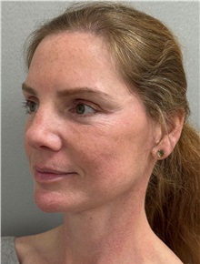 Facelift After Photo by Keshav Magge, MD; ,  - Case 50234