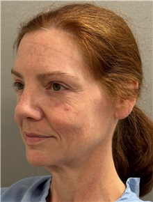 Facelift Before Photo by Keshav Magge, MD; ,  - Case 50234