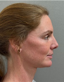 Facelift After Photo by Keshav Magge, MD; ,  - Case 50234