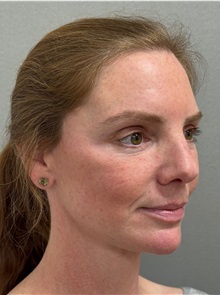 Facelift After Photo by Keshav Magge, MD; ,  - Case 50234