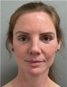 Facelift After Photo by Keshav Magge, MD; ,  - Case 50234
