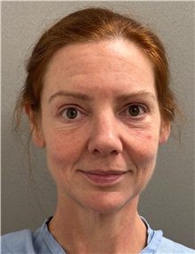 Facelift Before Photo by Keshav Magge, MD; ,  - Case 50234