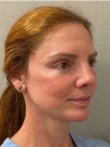 Facelift After Photo by Keshav Magge, MD; ,  - Case 50234 Facelift After Photo by Keshav Magge, MD; ,  - Case 50234