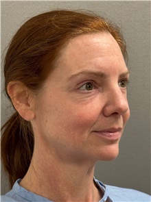 Facelift Before Photo by Keshav Magge, MD; ,  - Case 50234 Facelift Before Photo by Keshav Magge, MD; ,  - Case 50234