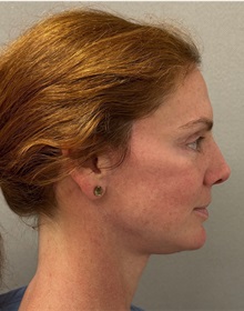 Facelift After Photo by Keshav Magge, MD; ,  - Case 50234