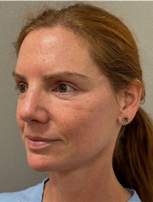 Facelift After Photo by Keshav Magge, MD; ,  - Case 50234