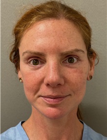 Facelift After Photo by Keshav Magge, MD; ,  - Case 50234