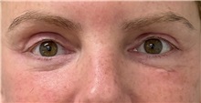 Eyelid Surgery After Photo by Keshav Magge, MD; ,  - Case 50235