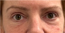 Eyelid Surgery Before Photo by Keshav Magge, MD; ,  - Case 50235