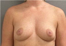 Breast Augmentation Before Photo by Keshav Magge, MD; ,  - Case 50251 Breast Augmentation Before Photo by Keshav Magge, MD; ,  - Case 50251