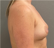 Breast Augmentation Before Photo by Keshav Magge, MD; ,  - Case 50251