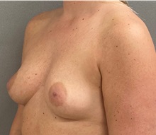 Breast Augmentation Before Photo by Keshav Magge, MD; ,  - Case 50251