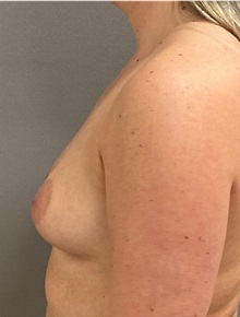 Breast Augmentation Before Photo by Keshav Magge, MD; ,  - Case 50251