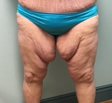 Flabby inner thighs discount before and after