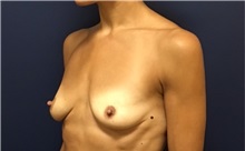 Breast Augmentation Before Photo by Brian Pinsky, MD, FACS; Huntington Station, NY - Case 35465